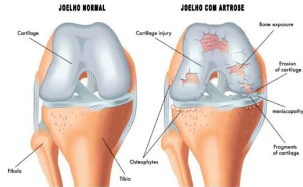 Artrose no Joelho e Exercícios