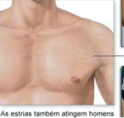 Entenda alguns alimentos proteicos e também como evitar estrias na musculação