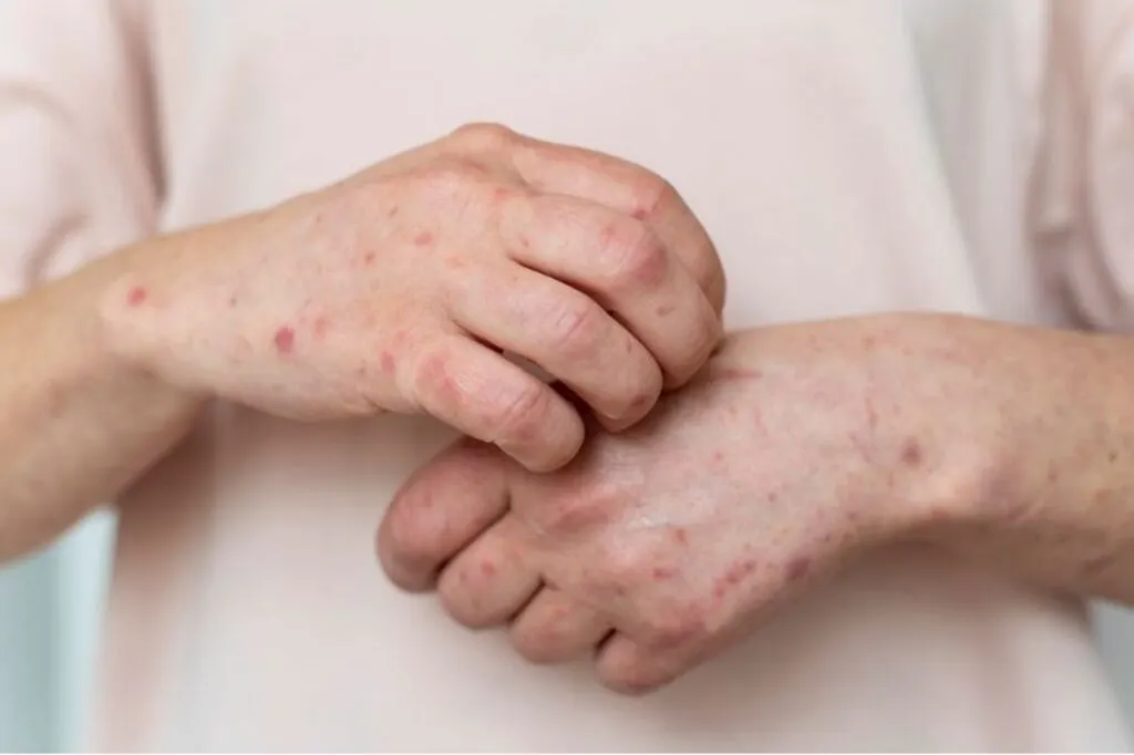 Dermatite atópica: 10 fatores que podem agravar a doença