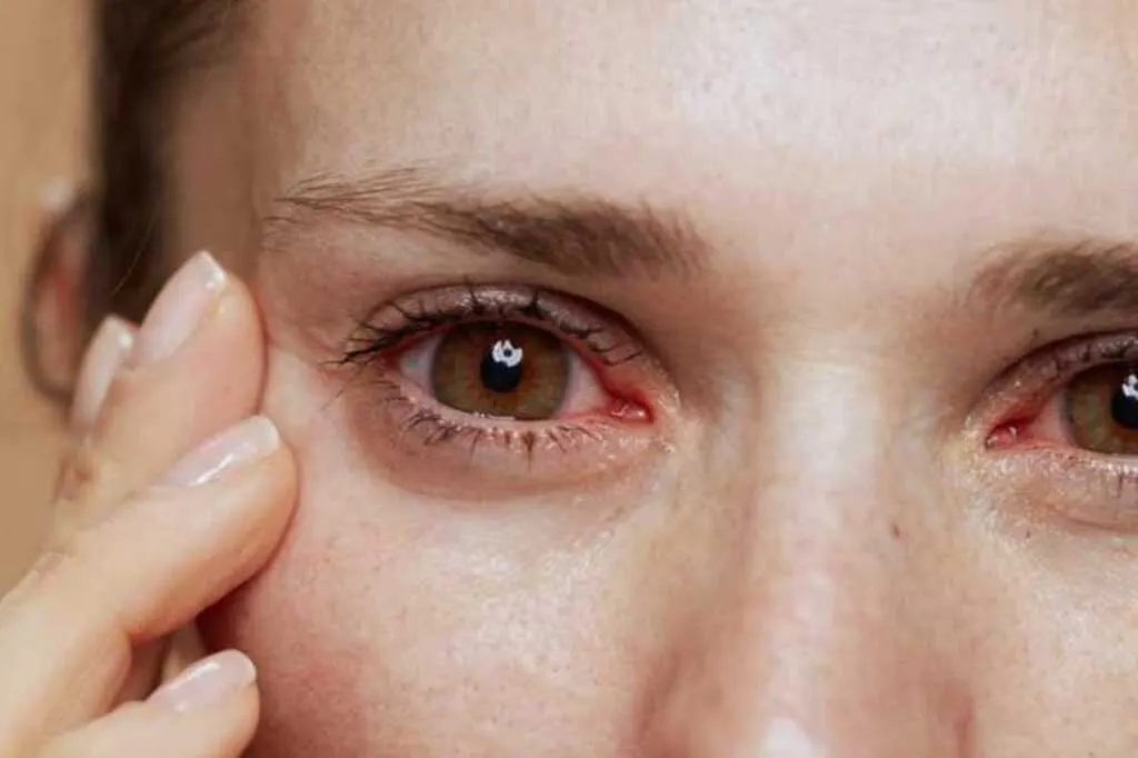 Sociedade Catarinense de Oftalmologia alerta para alergias oculares na primavera